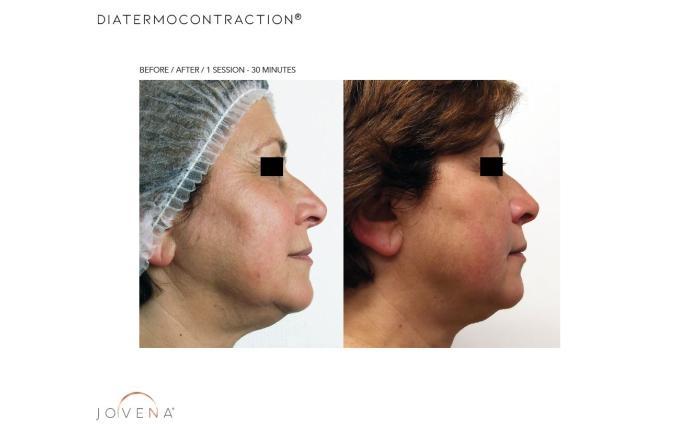 Jovena® medicinski uređaj