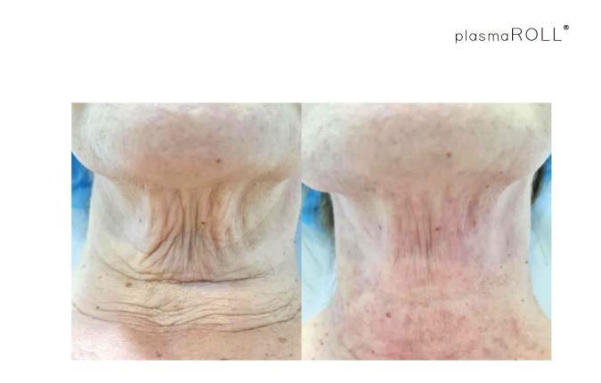 Jovena® medicinski uređaj