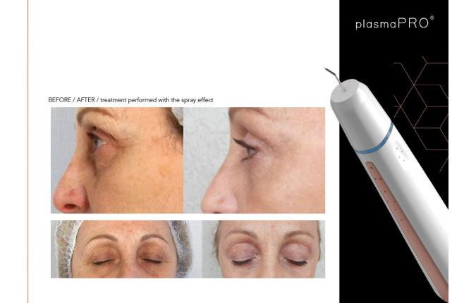 Jovena® medicinski uređaj
