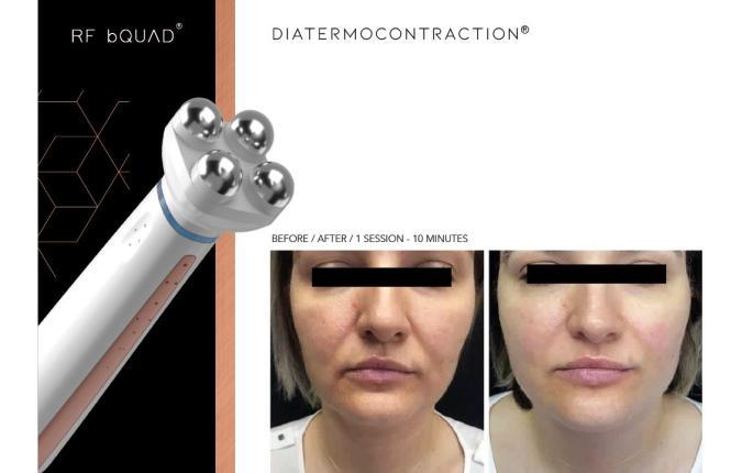 Jovena® medicinski uređaj